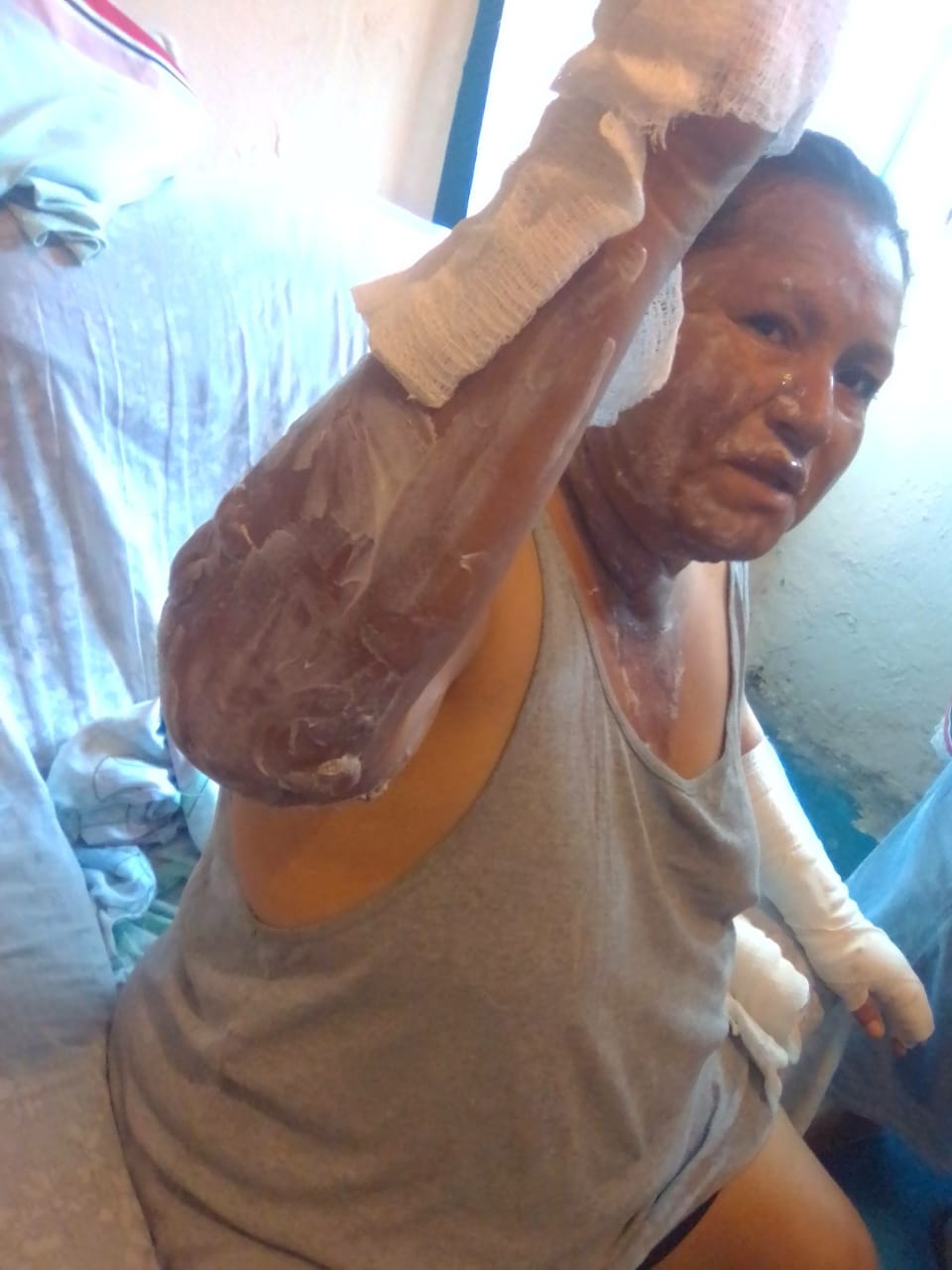 Por falta de medicamentos no atienden a mujeres quemadas en hospital de Veracruz   