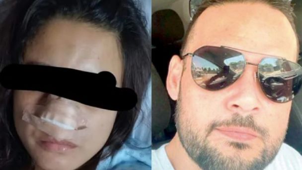 Yeri MUA regalará cirugía estética a joven que le arrancaron la nariz de una mordida