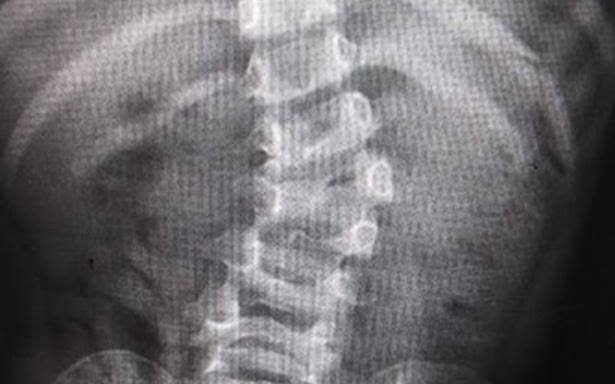 Lumbalgia, una de las afecciones más comunes en la población adulta