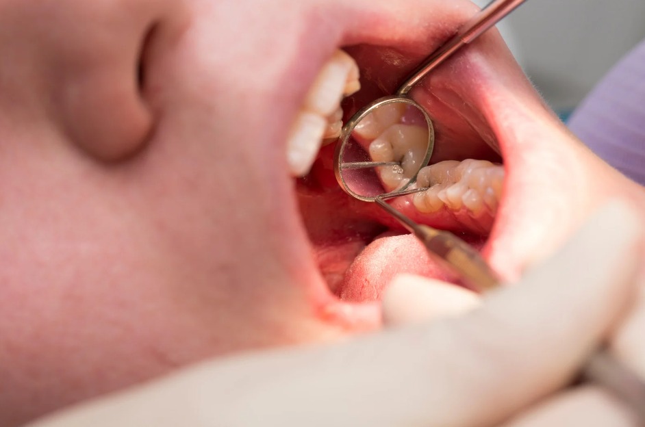 Importante atender caries oportunamente para evitar pérdidas dentales