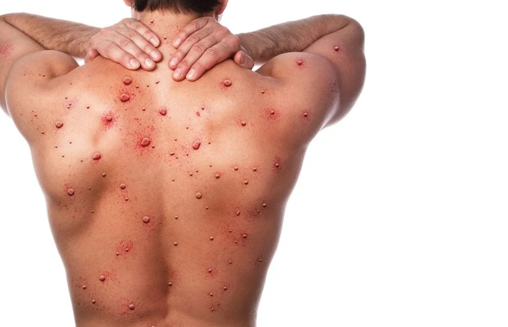 MPOX, enfermedad leve y de baja mortalidad, aunque en algunos casos puede ser grave