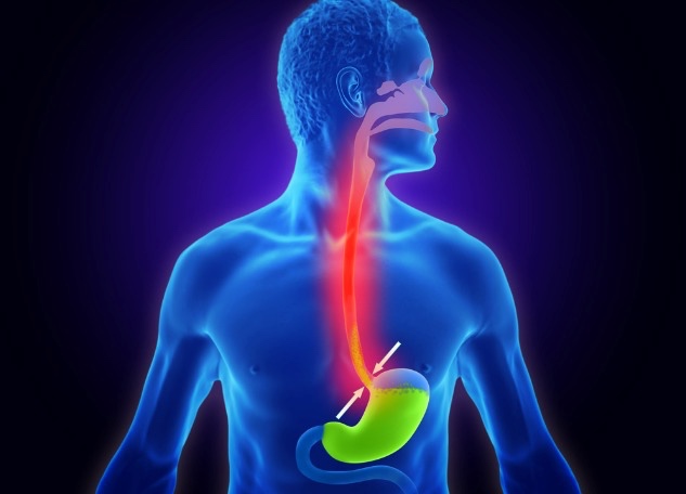 Importante atender con tiempo la enfermedad de reflujo gastroesofágico