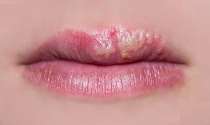 Llaman a tomar previsiones para evitar complicaciones en torno al herpes labial