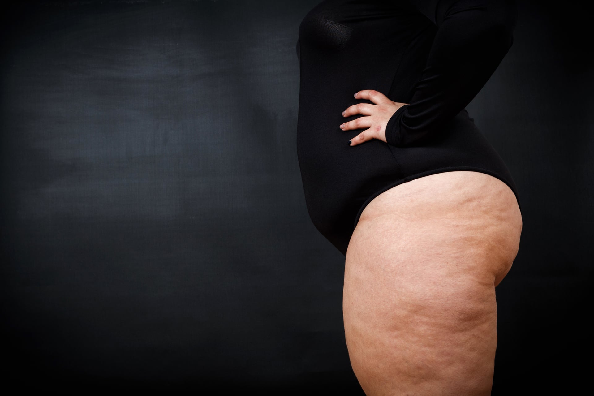 Diagnóstico temprano del lipedema mejora la calidad de vida