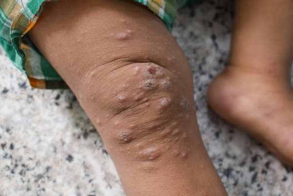 Mpox o viruela símica puede derivar en complicaciones graves si no se atiende a tiempo