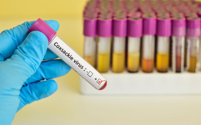 Virus Coxsackie en Veracruz: 71 casos atendidos en escuelas