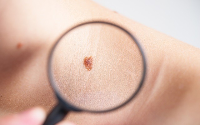 Detección temprana de melanoma es clave