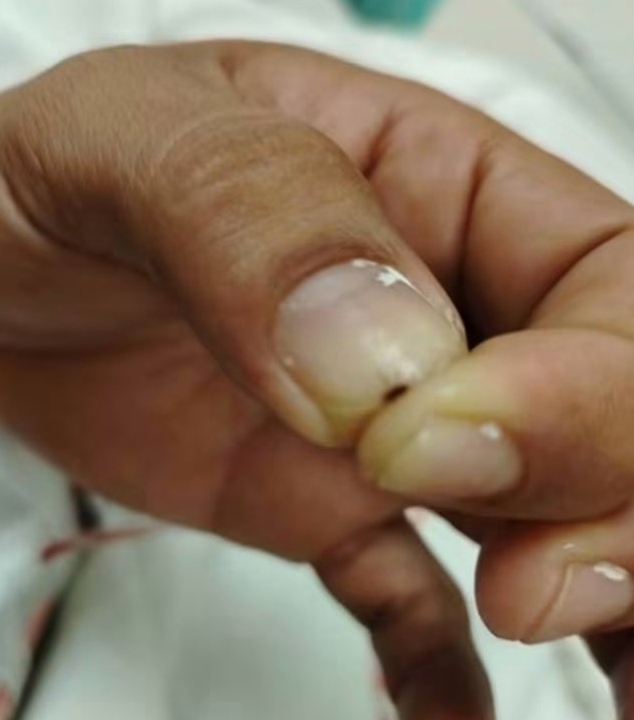 Denuncian supuesta presencia de garrapatas en sábanas de Urgencias del Hospital General de Zona 71 del IMSS de Veracruz